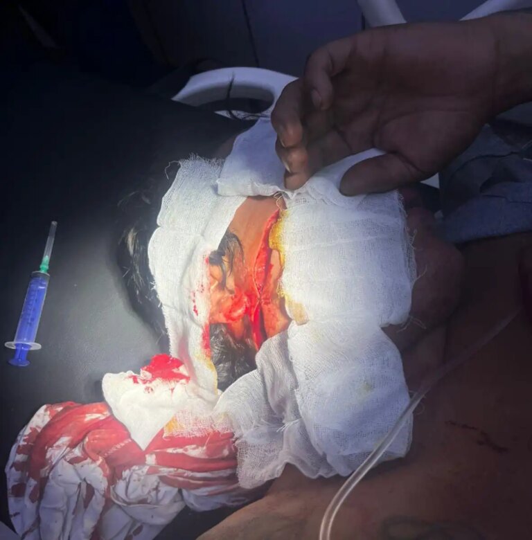 Hombre con antecedentes es herido con un machete en el rostro en Pedro Juan Caballero